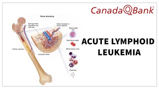 Acute Lymphoid Leukemia (ALL)