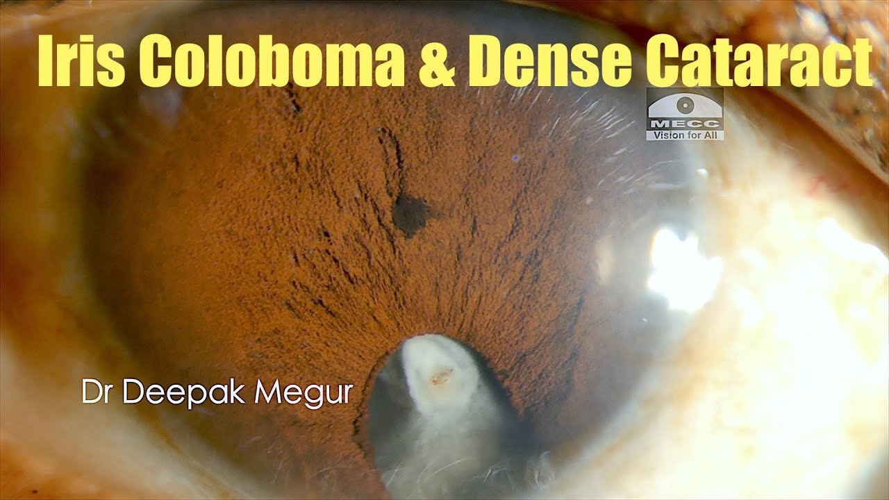 coloboma iris viziune vedere încețoșată cu candidoză