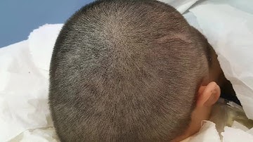 Scalp Micropigmentation SMP Density Restoration by El Truchan @ Scalp Micro Definition London