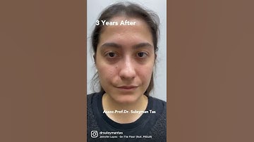 Correction Of Severe Crooked Nose Deformity | Dr. TAS