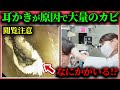 【耳鼻科の耳掃除】耳の中に大量のカビ…“本当の原因は耳かき”でした
