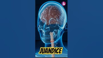 Jaundice || Types, Causes, Symptoms and Treatment #jaundice #medical #shorts