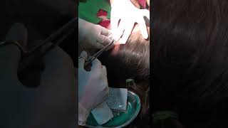 Epidermoid Cysts (or Epidermal Inclusion Cyst) Removal from earlobe.