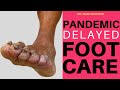 Pandemic Delayed Foot Care: Severe Fungal Toenail Trimming