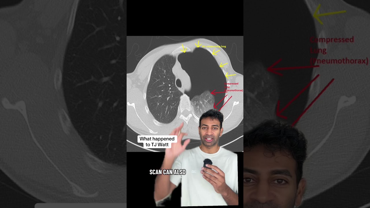 TJ Watt lung breakdown by a sports doctor 