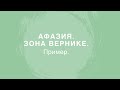 ИНСУЛЬТА. СЕНСОРНАЯ АФАЗИЯ (зона Вернике). Обследование пациента/Fluent aphasia