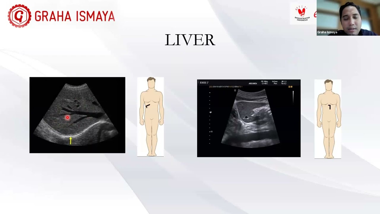 Pertemuan Online Bulan Juni 2023. Pemeriksaan USG Abdomen dengan menggunakan USG GTM APF5020