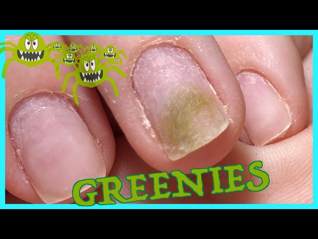 What Causes Green Fingernails? Blue Fingernails? | Faculty of Medicine