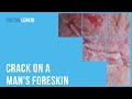😨 Crack on a man’s foreskin