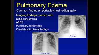 edema atelectasis and consoldiation