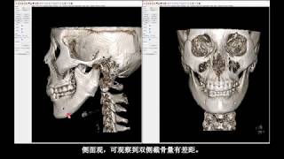 下颌角重建修复手术 [H整形医院]  韩国整形医院