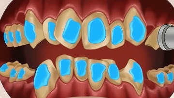 ASM teeth braces : Animation Project completed for client using Moho