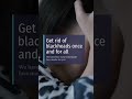 HOME REMEDIES TO REMOVE BLACKHEADS | DIY REMOVE BLACKHEADS PERMENANTALY