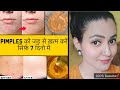 In 7 Days 💕 PIMPLES को जड़ से खत्म करें सिर्फ 7 दिनों में और पाए बेदाग़ Spotless Glowing Skin 100%