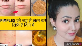 In 7 Days 💕 PIMPLES को जड़ से खत्म करें सिर्फ 7 दिनों में और पाए बेदाग़ Spotless Glowing Skin 100% screenshot 4