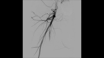 TruePath CTO Cross with Distal Tip Reshaping