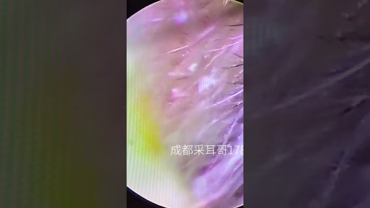 Satisfying Video Ear Wax Removal how to remove ear wax by endoscopic