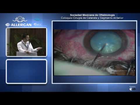 Faco en catarata intumescente - Dr. Erick Mendoza Schuster Ortiz - Módulo III - 25 de Mayo del 2013