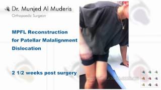 MPFL Reconstruction for Patellar Malalignment Dislocation - 2 1/2 weeks post surgery