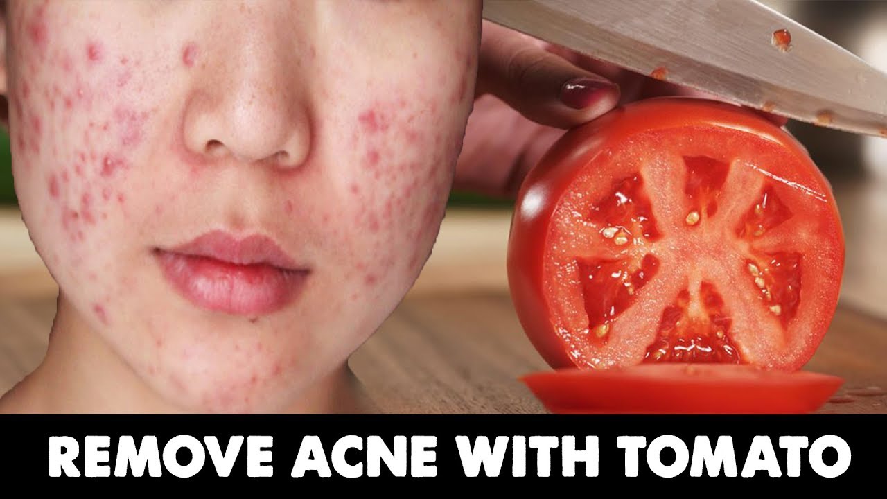 How To Remove Acne With Tomato Quick Acne Treatment YouTube