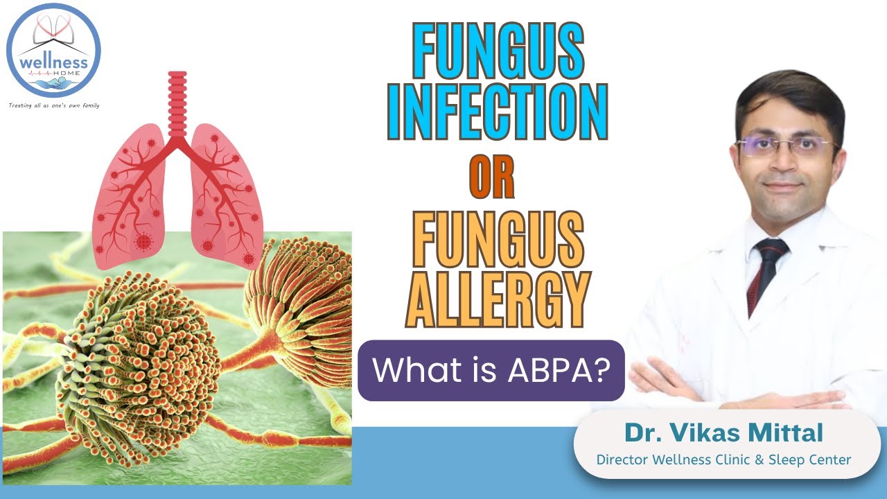 Inspiring stories of care & recovery ABPA | What is ABPA? | Aspergillosis: Symptoms & Treatment