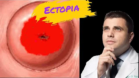 O que causa ectopia?