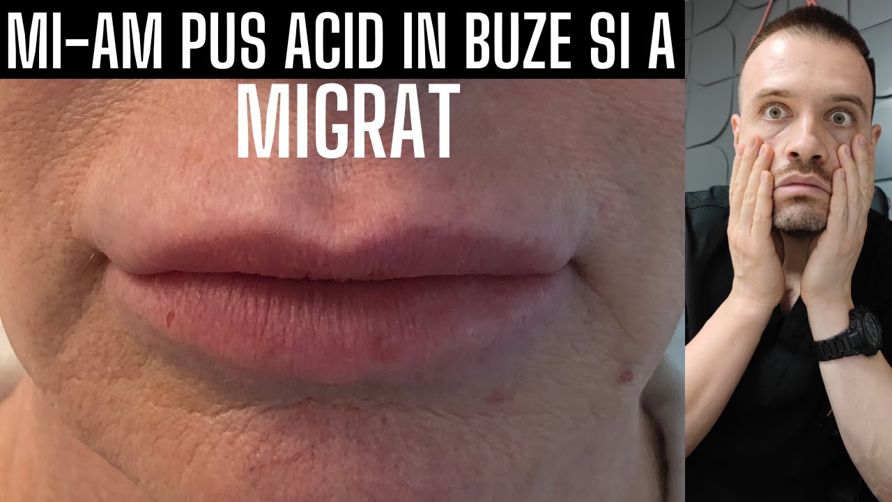 Mi-am pus ACID HIALURONIC in BUZE si a MIGRAT