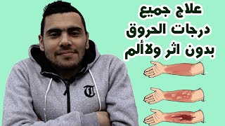 علاج الحروق في المنزل | الاسعافات الاولية للحروق | علاج الحروق عند الاطفال | بتوع الدوا