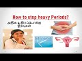 Mirena Treatment for Heavy Menstrual Periods | அதிக உதிரப்போக்கு  தீர்வுகள் | Dr. Deepa Ganesh.