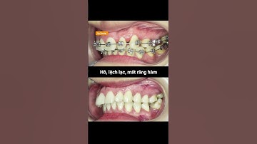 Cận cảnh quá trình điều trị hô, lệch lạc và mất răng hàm