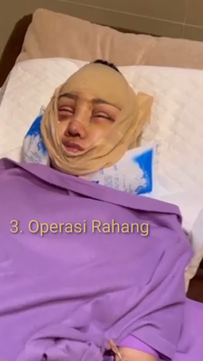 Inilah Wajah Lucinta Luna Pasca Operasi