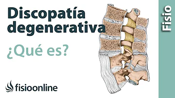 ¿Qué significa L4 y L5 degenerativas?