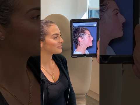 One-Year Post-Rhinoplasty
