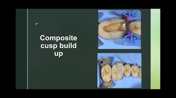 Composite cusp build up #stepbystep