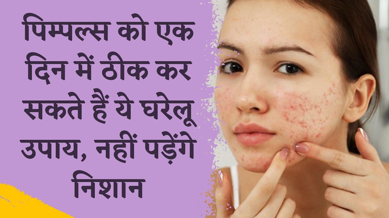 How To Remove Pimples Overnight | Acne Treatment | Dr manoj das