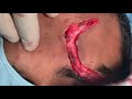 Eyebrow and forehead Scar removed with fine plastic surgery by prof dr sunil richardsonand Forehead