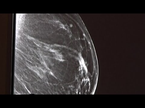 Wideo: Czy zwapnienie piersi może zniknąć?