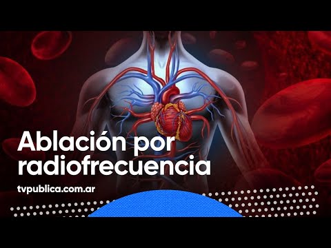 Video: ¿Cuándo se inventó la ablación por radiofrecuencia?