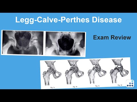 Legg-Calve-Perthes Disease Exam Review - William Jiranek, MD