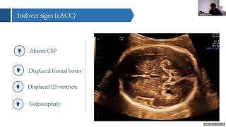 Corpus Callosum: How easy diagnosis? (Francesco D’Antonio)