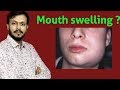 Why swelling in mouth | मुँह मे सूजन क्यों आती है | Mouth Swelling Treatment in Hindi |