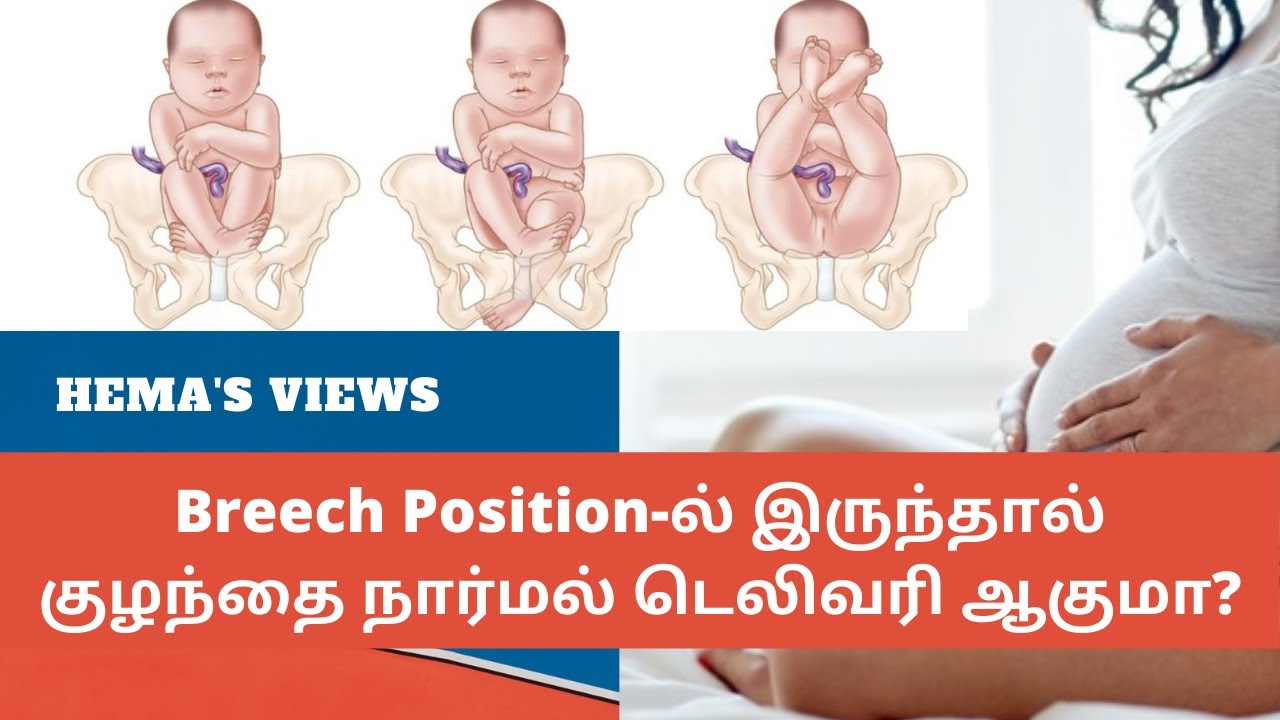 breech presentation tamil