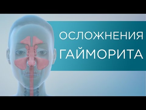 ОСЛОЖНЕНИЯ ГАЙМОРИТА