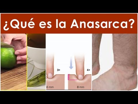 Vídeo: Anasarka - Causas, Síntomas Y Tratamiento De Anasarka