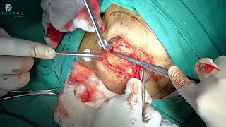 Short Incision Lipoma Excision: A Minimally Invasive Approach
