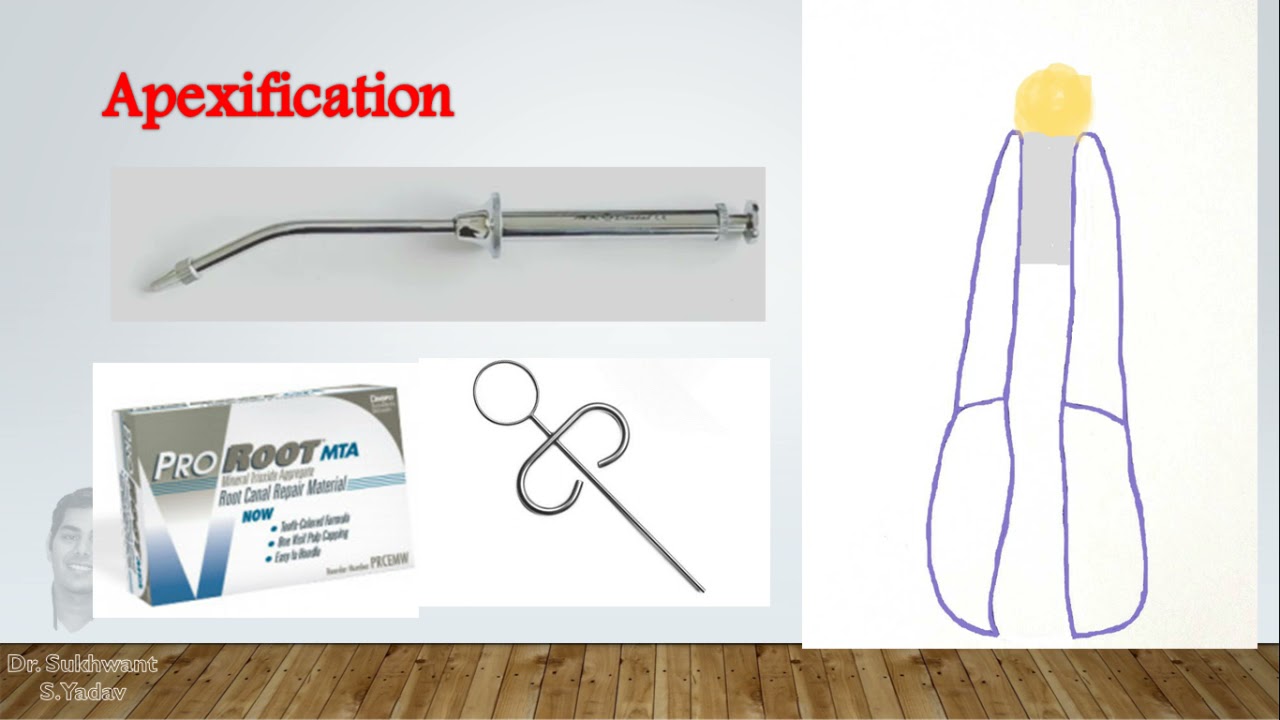 Open apex Management Part 2 - MTA Apexification