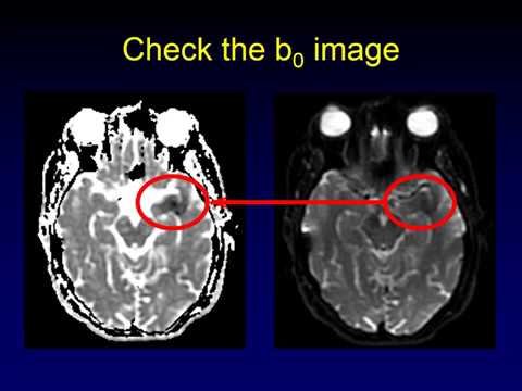 ADC versus DWI
