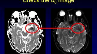 ADC versus DWI