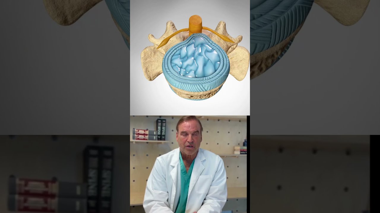 An Orthopedic Surgeon S Guide Bulging Vs Herniated Discs In The Spine Backpain Backinjury