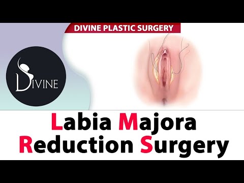 Labiaplasty Surgery | Labia Majora Reduction | Vagina Tightening In Delhi 2021 | Labia Majoraplasty